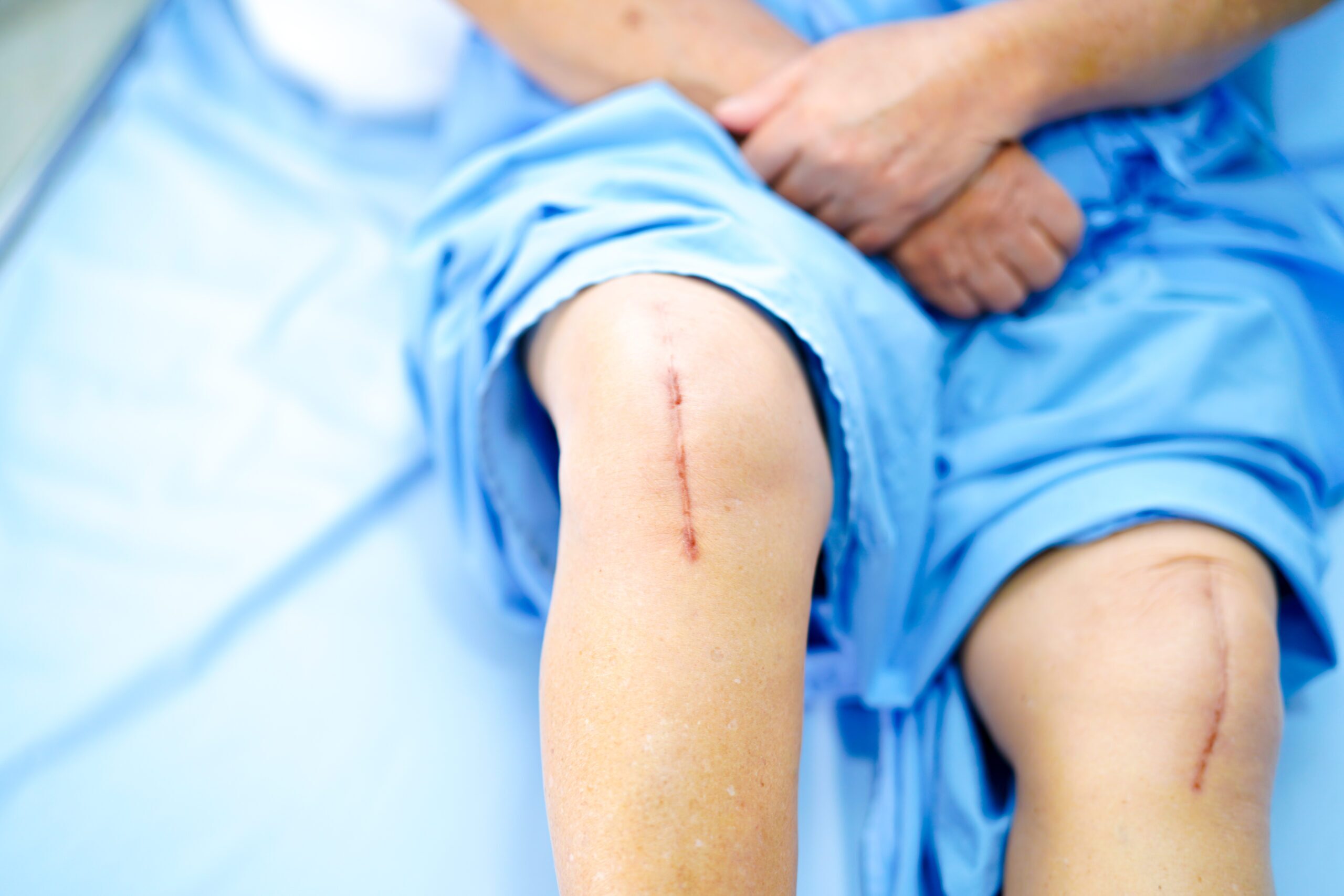 Double knee replacement